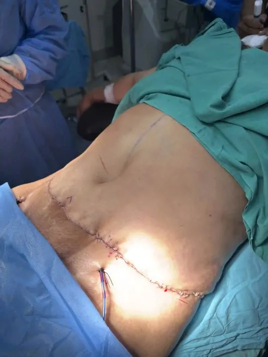 Tummy Tuck